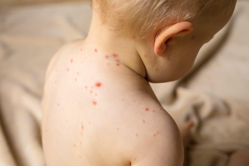 2019 had more measles cases than any year since 2000